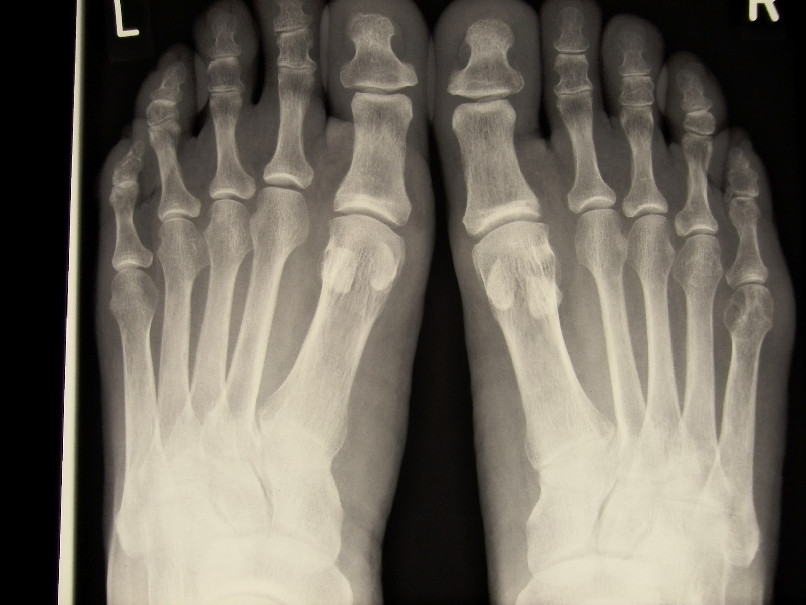 Rheumatologe Rheumatoid Arthritis Radiographic Progression