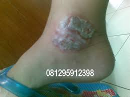 Foto Solusi Alami Untuk Menghilangkan Gatal Eksim Di Mata Kaki Yang Menahun