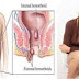 Obat Ambeien Manjur thumbnail
