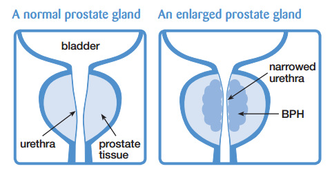 Beauty Angel: Prostate Ring