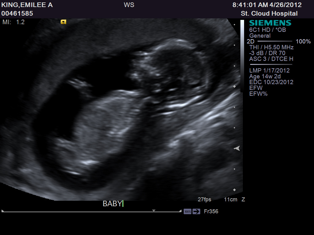 Lillie Mae: 14 Week Ultrasound Pictures: