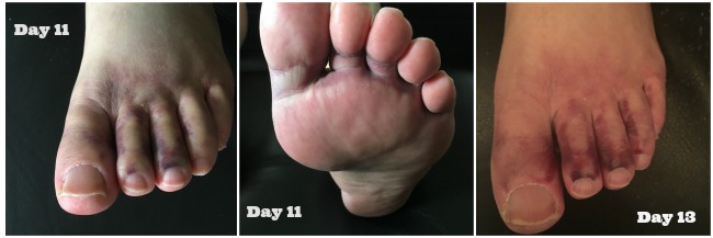 Hip-replacement-one-mans-journey-week-2-collage-images-bruised-toes-day-11-and-day-13