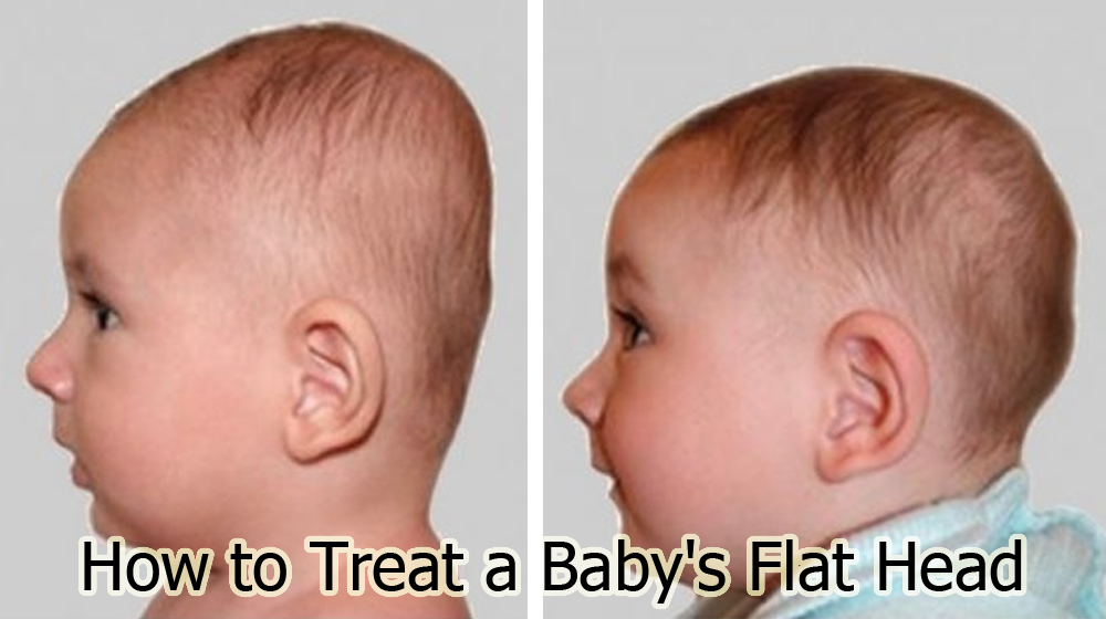 How to Treat a Baby's Flat Head