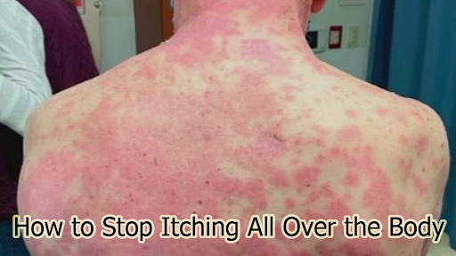 How to Stop Itching All Over the Body