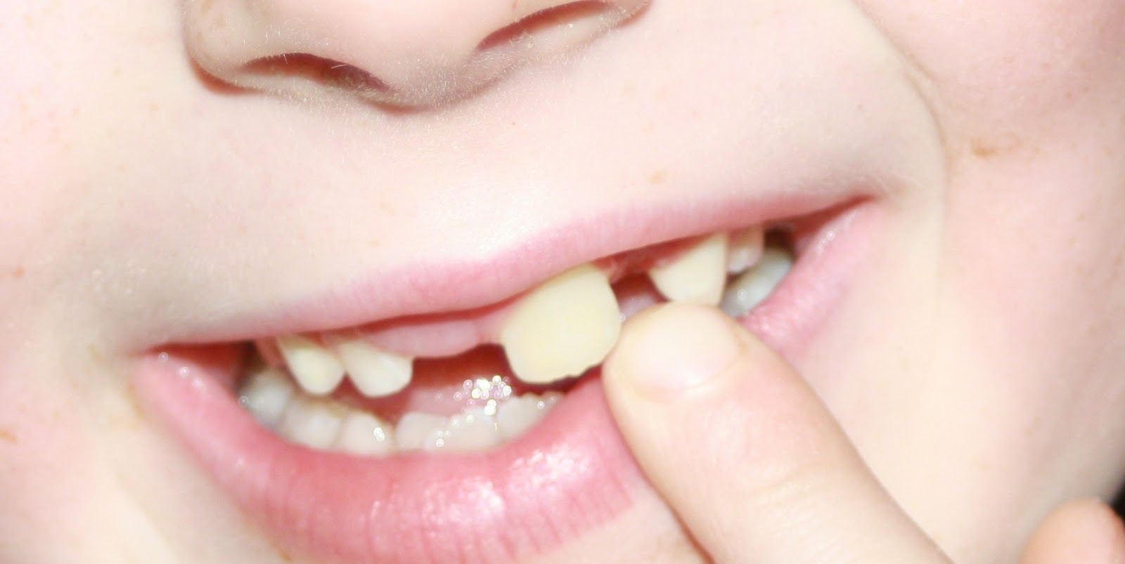 Ребенок год скрежет зубами. Зуб растет из десны у ребенка. Маленький ребенок скрипит зубами молочными 1 год. На нёбе растут зубы заболевание.