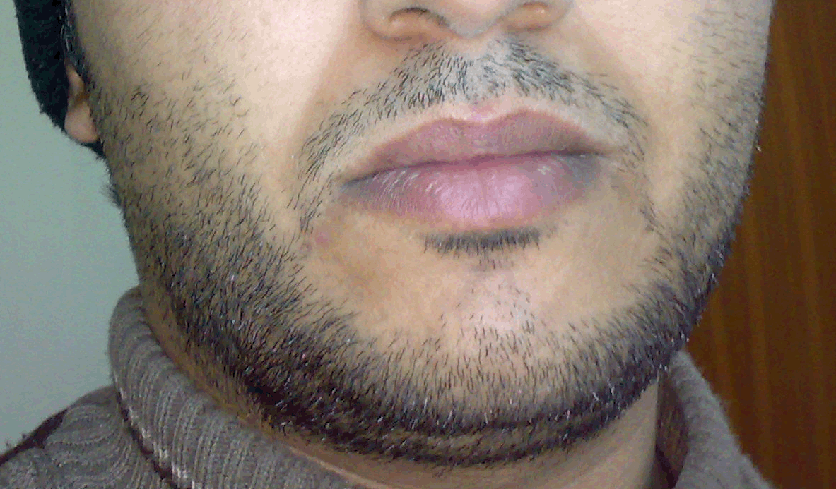 Рост волос на лице у мужчин. Двухнедельная щетина. Щетина 5 мм. Щетина 3 мм. Небритый подбородок.