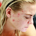 How to Remove Pimples at Home | 20 Household Remedies for Pimples / Acne Removal | what are pimples?