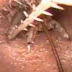 Ανατριχιαστικό βίντεο: Στο αυτί ασθενούς «κατοικούσε» έντομο μήκους 7,5 εκατοστών!