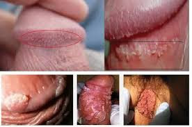 Image Cara menyembuhakan kutil di sekitar penis