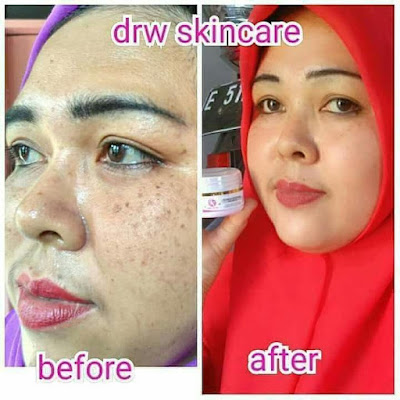 drw skincare Lampung Tengah