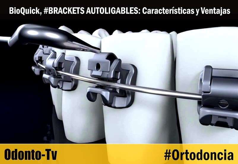 BioQuick, BRACKETS AUTOLIGABLES Características y Ventajas