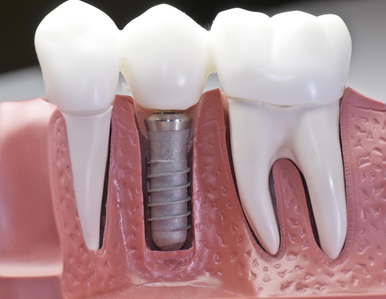 Seattle Dental Implants Seattle Dental implants