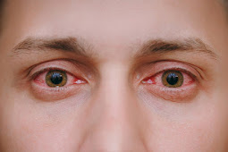 How To Treat Red Eyes From Contact Lenses