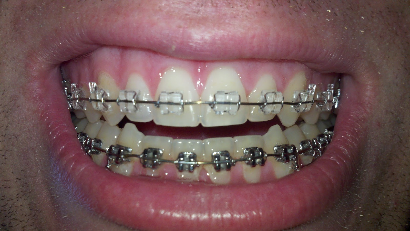Braces/Open Bite Surgery FINALLY Sure Smile Wires are in!
