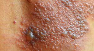 Foto Obat Herpes Alami Cepat Dan Ampuh tersedia di apotik