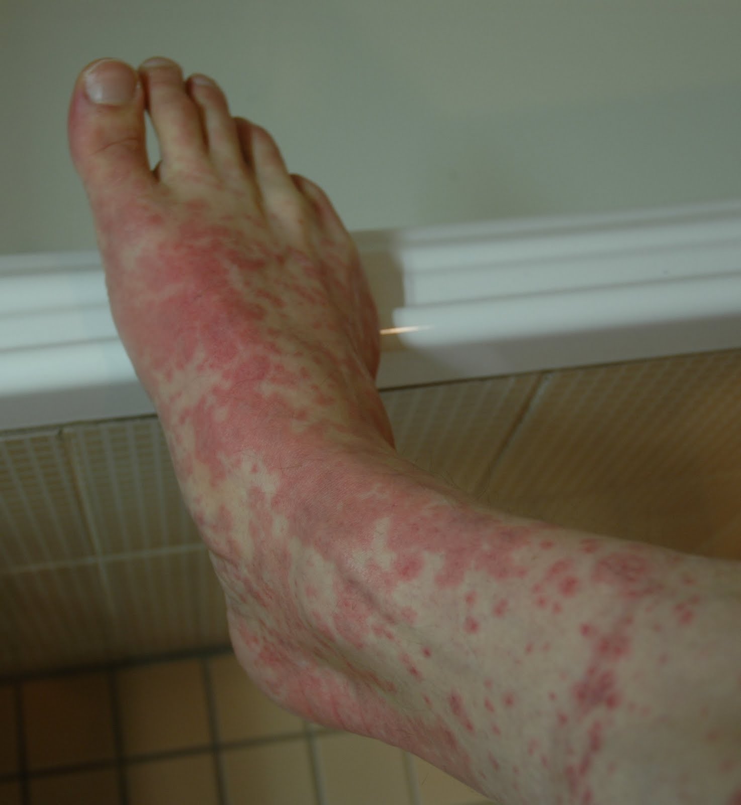 Skin Rashes On Legs And Feet - Doctor answers on HealthTap