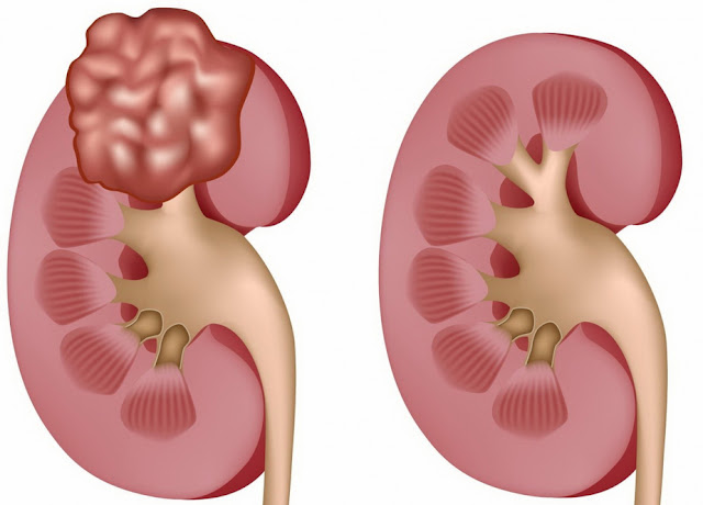 symptom and signs of kidney infection symptom and signs of kidney infection