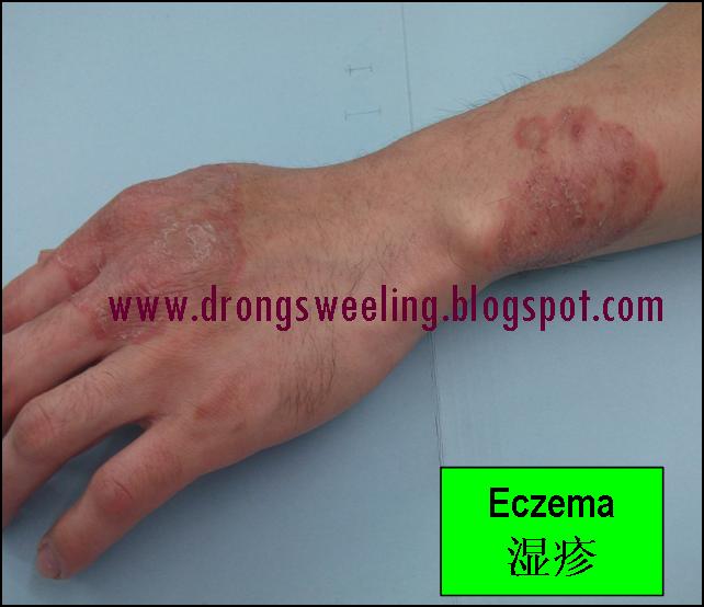 TCM News How Effective Can TCM Cure Eczema 湿疹 with Chinese Natural Herbs