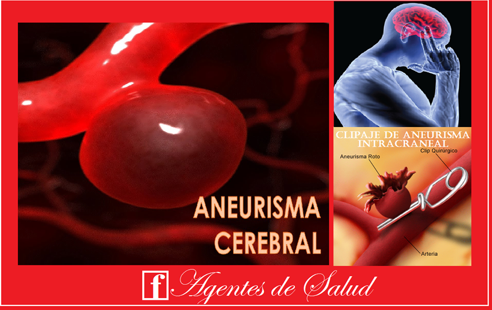 Agentes de Salud Aneurisma Cerebral Agentes de Salud Aneurisma Cerebral