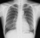 胸部X線の学習