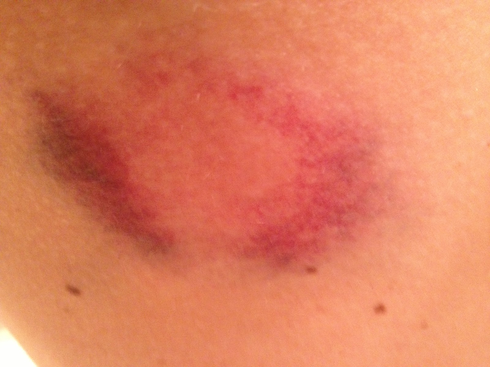 My 30 before 30 Challenge Bruises Fade. Wounds Heal