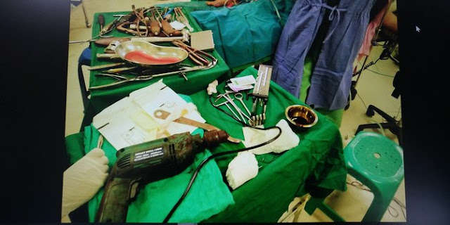 Waduh, Dokter Bedah di Kaltim ini Pakai Bor Bangunan Buat Operasi Pasien