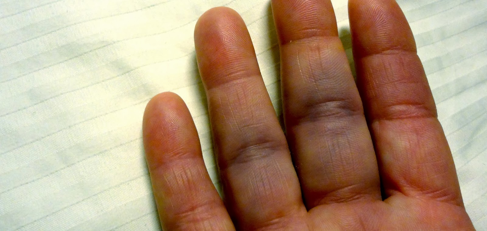 Swollen Purple Fingertips at Daniella Turner blog