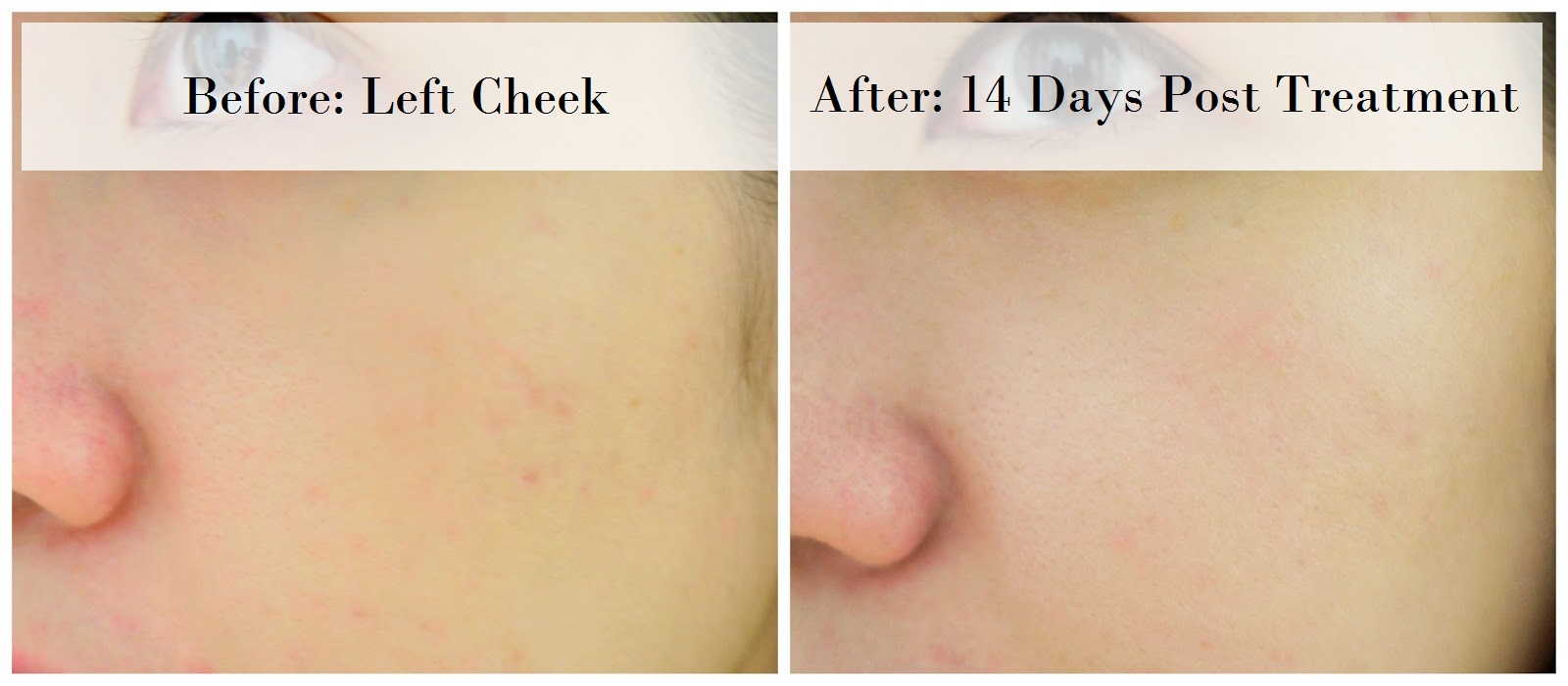 best skin resurfacing carbon fractional co2 laser treatment me aesthetic clinic time square kl review