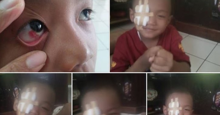 Mata Anak Ini berdarah, Diduga akibat Sering Main Gadget