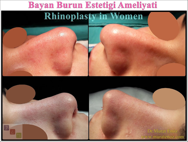 Female Nose Aesthetic Surgery - Female Nose Job - Rhinoplasty in Women Istanbul - Rhinoplasty in Women Turkey - Nose Jobs For Women - Women's Rhinoplasty - Female Rhinoplasty Istanbul - Nose Reshaping for Women