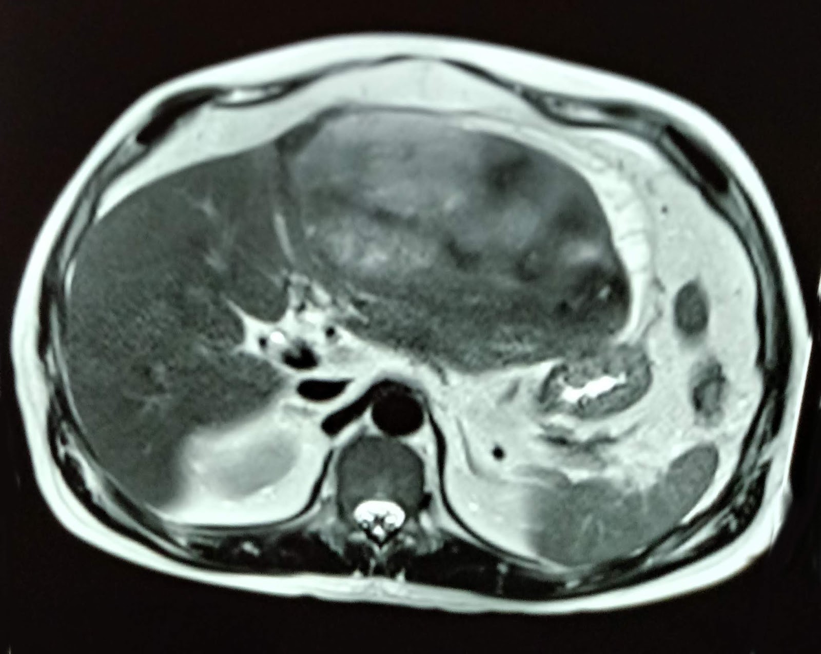 drenaje de hematoma abdominal