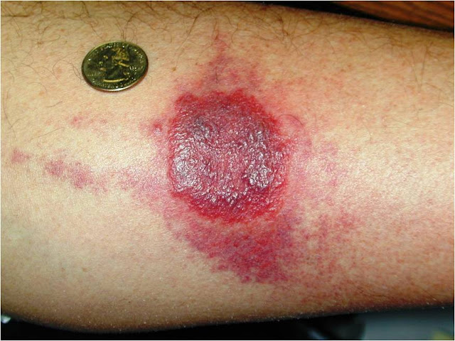 bed bug rash reaction allergic bed-bug-rash-reaction-allergic