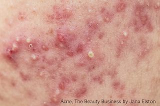 how to get rid of acne the beauty business blog by jana elston how to get rid of acne the beauty business blog by jana elston