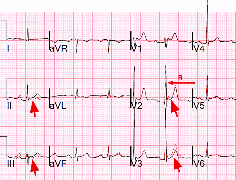 Отведение avr на экг норма. Avr отведение экг. Avr отведение экг. Avf отведение экг. Avr avl avf отведения на экг.