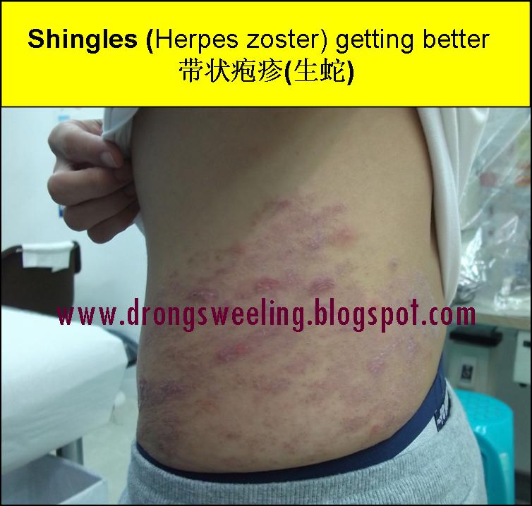 TCM News Best TCM Doctor for Shingles, Herpes Zoster, Postherpetic Neuralgia
