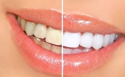 Foto Gigi Putih Cara Mudah Putihkan Gigi Kuning dengan Bahan Alami Tanpa Efek Samping 