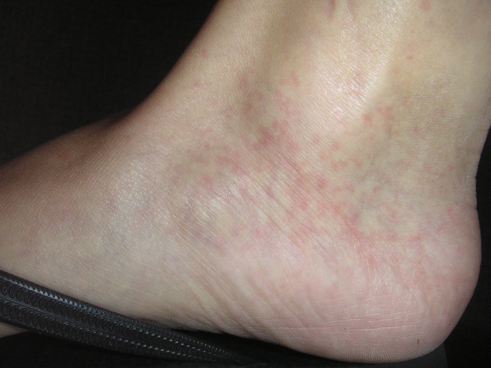 red spots on ankles