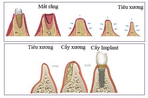 ĐÁNH GIÁ TIÊU CHUẨN CHẤT LƯỢNG XƯƠNG HÀM TRONG CẤY GHÉP IMPLANT -1