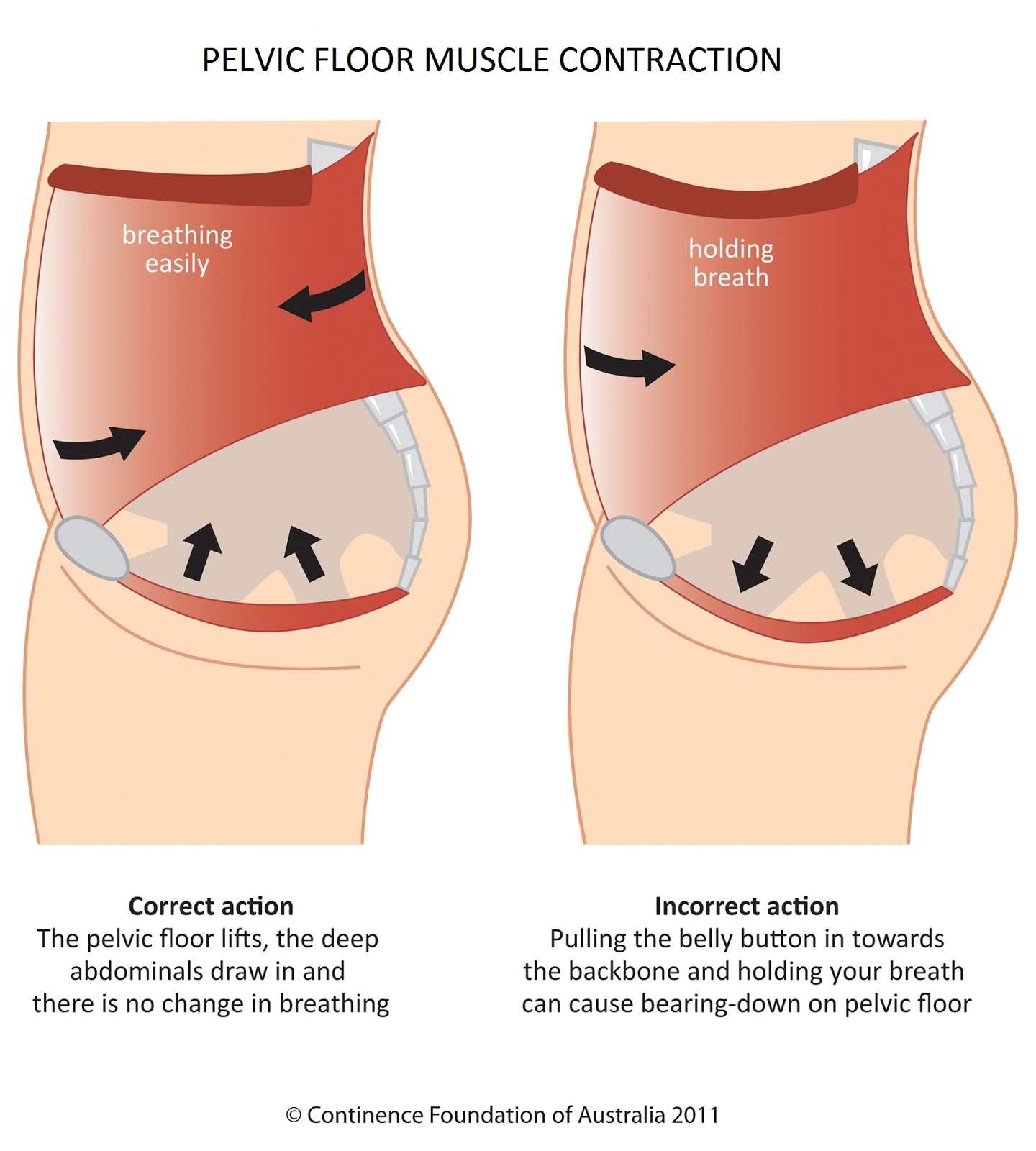 Robin Angus' Physical Therapy Blog Postpartum Abdominal Wall and Pelvic Floor Muscle