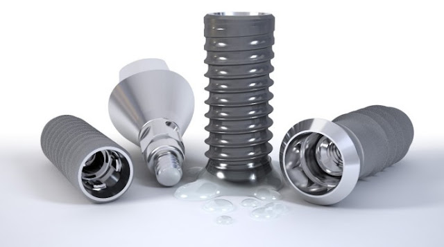 cong nghe làm răng implant cong nghe làm răng implant