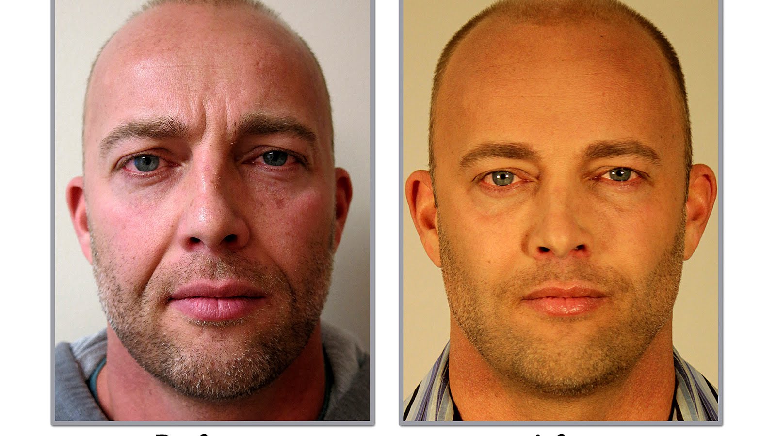 Best Non Invasive Face Lift Lift Choices