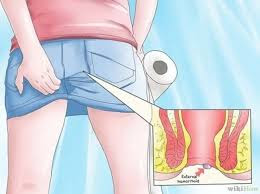 Foto Mencari Obat Ciri Ciri Ambeien Wasir Luar Paling Tepat