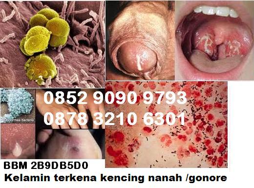 Alternatif Pengobatan Kencing Nanah Selain Secara Medis Alternatif Pengobatan Kencing Nanah Selain Secara Medis