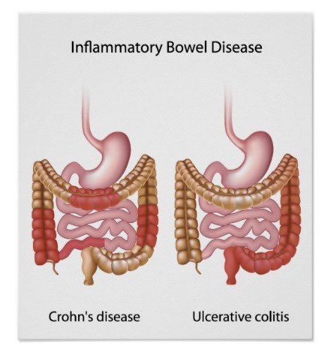 Crohn’s disease vs. Ulcerative colitis