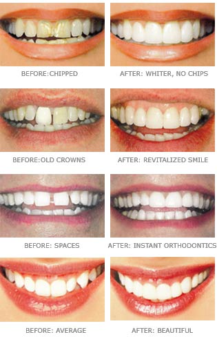 Lumineers World - save your teeth with us!: Lumineers are used for what?
