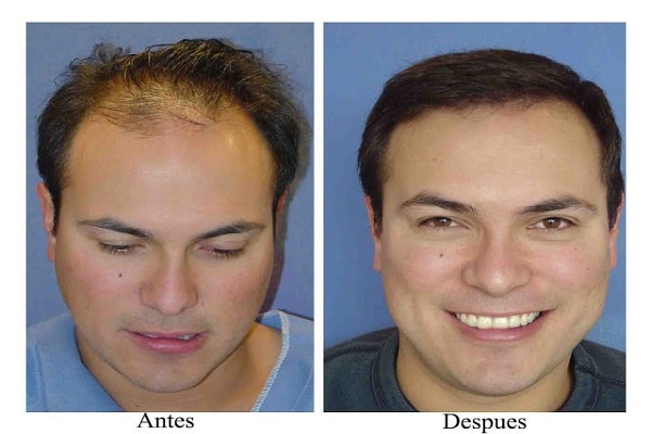Hair Transplantation in The Decision Making Process