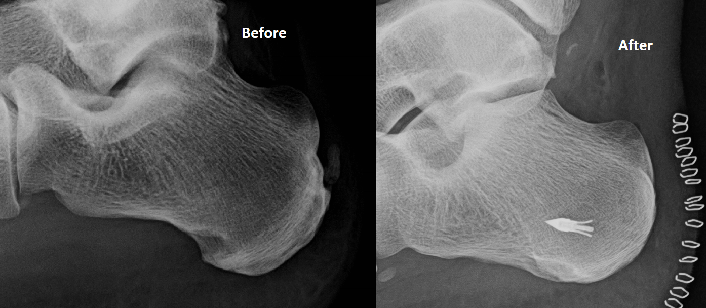 Daves Tech Trek Heal Bone Spur Surgery Recovery Experience