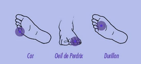 Durillon, cor, œil de perdrix traitement huiles essentielles