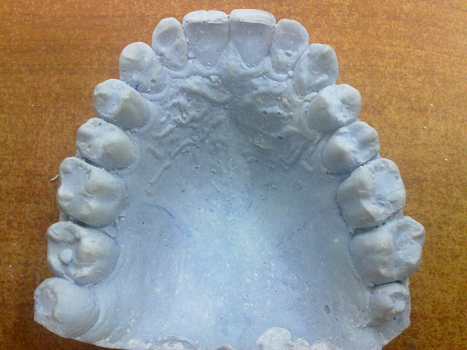 جهاز التثبيت (retainer) Smile maker