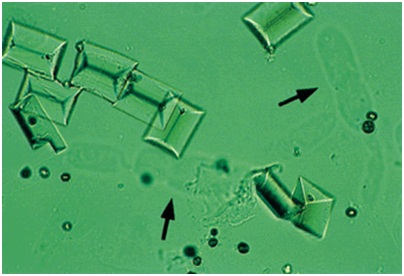 What's New Today?: Mikroskopis urinalysis - Kristal 